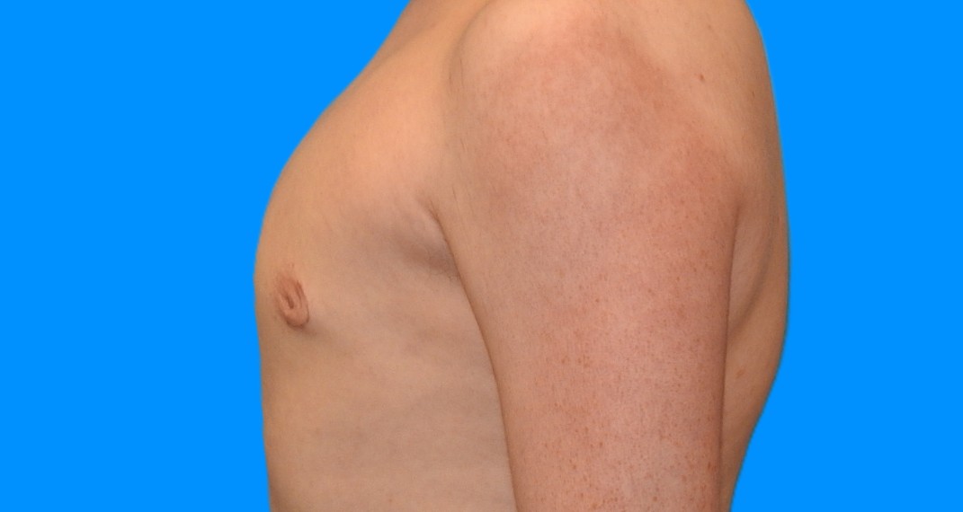 After Image: Patient Case #0147 - left-side