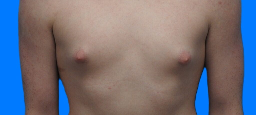 Before Image: Patient Case #0147 - front