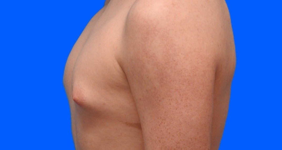 Before Image: Patient Case #0147 - left-side