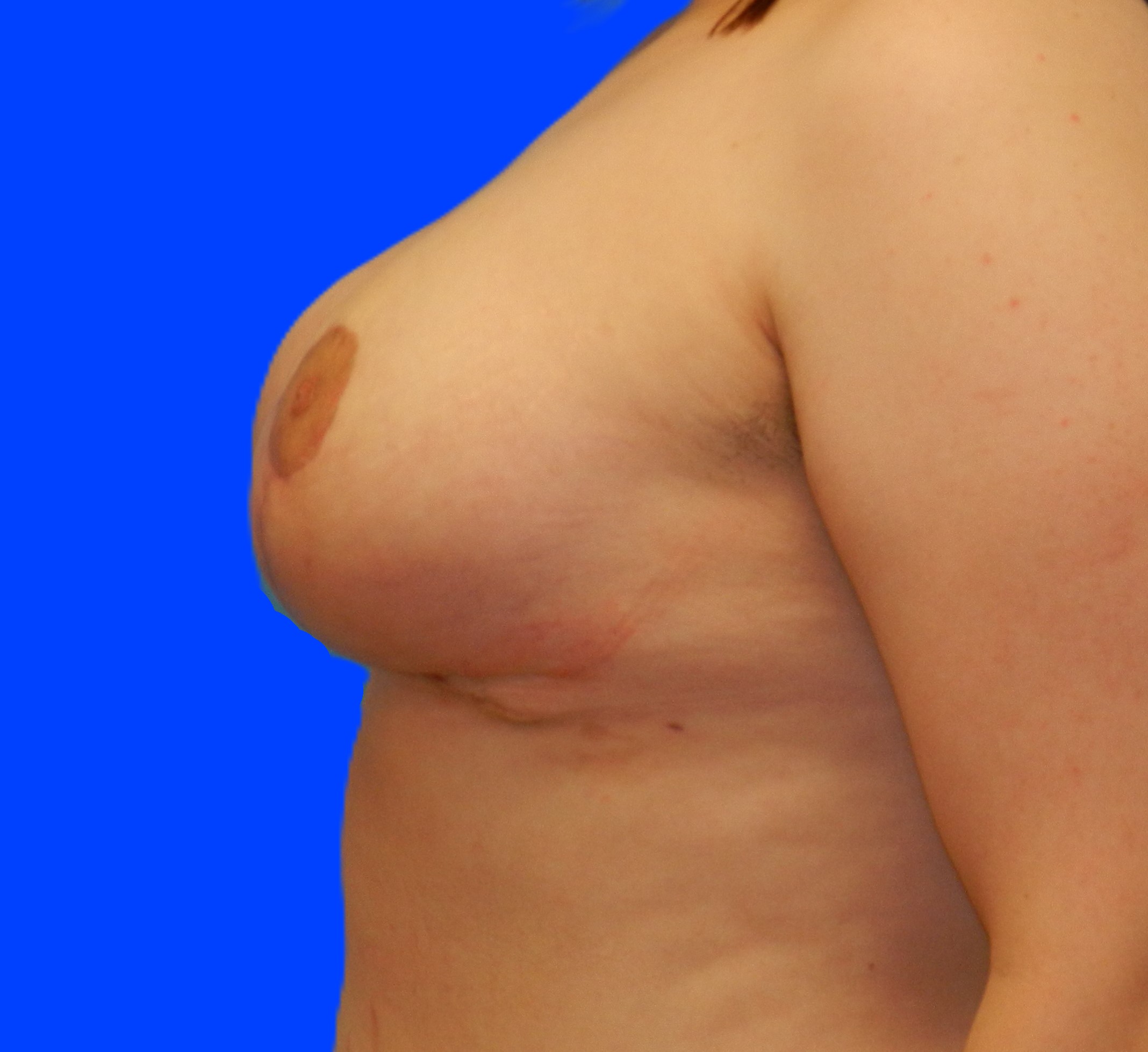 After Image: Patient Case #0148 - left-side