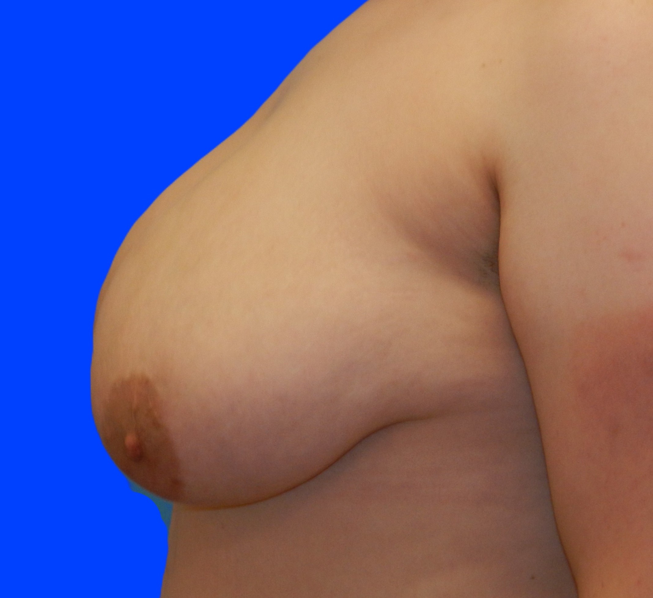 Before Image: Patient Case #0148 - left-side