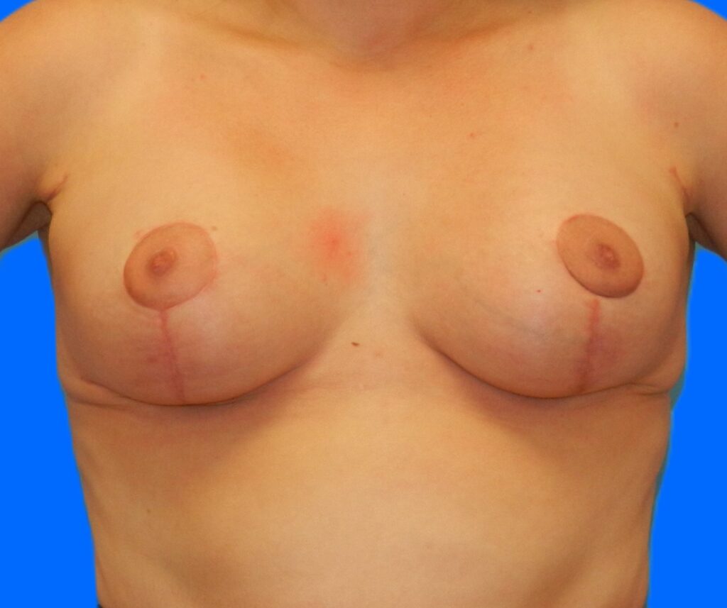 After Image: Patient Case #0149 - front