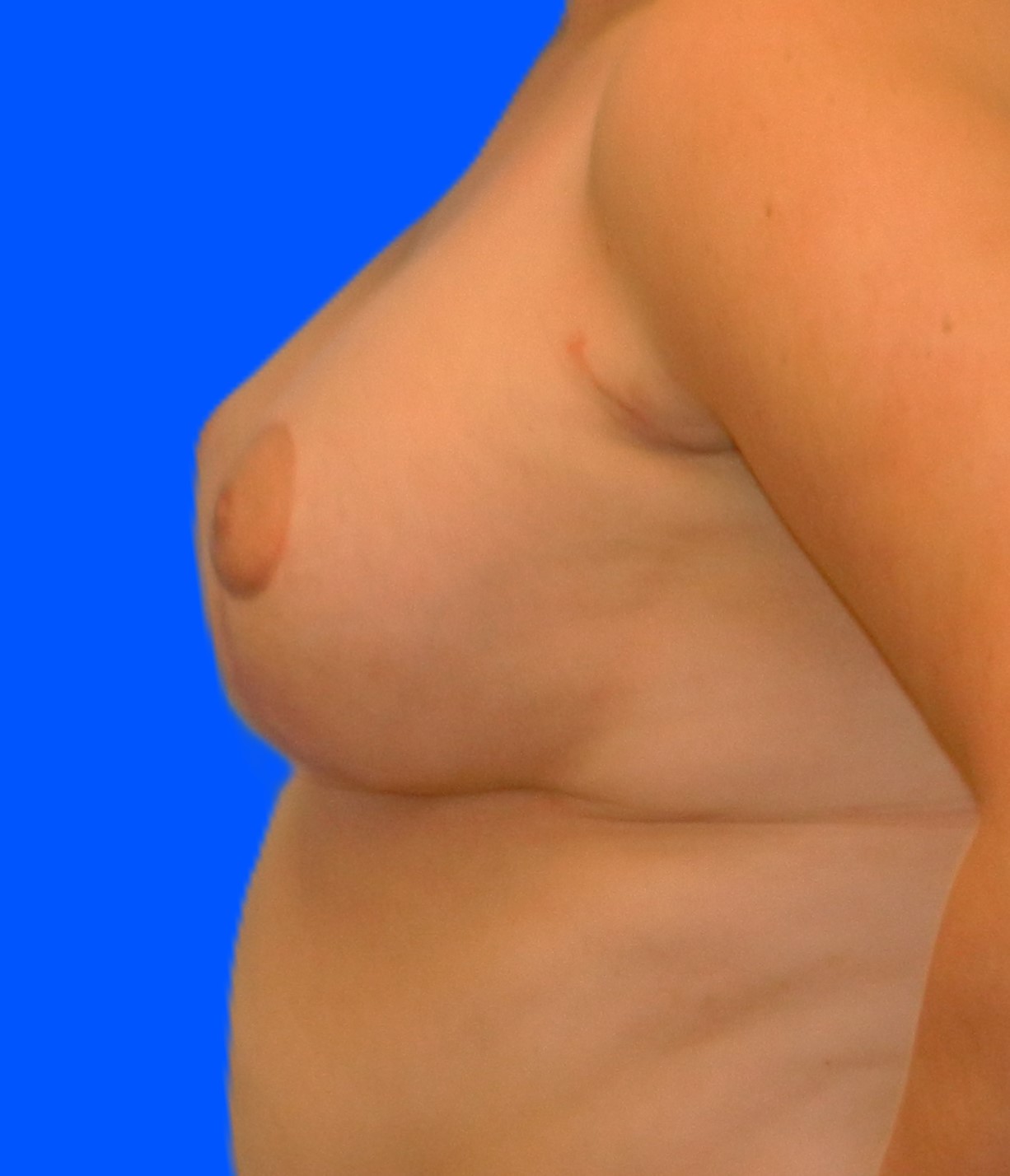 After Image: Patient Case #0149 - left-side