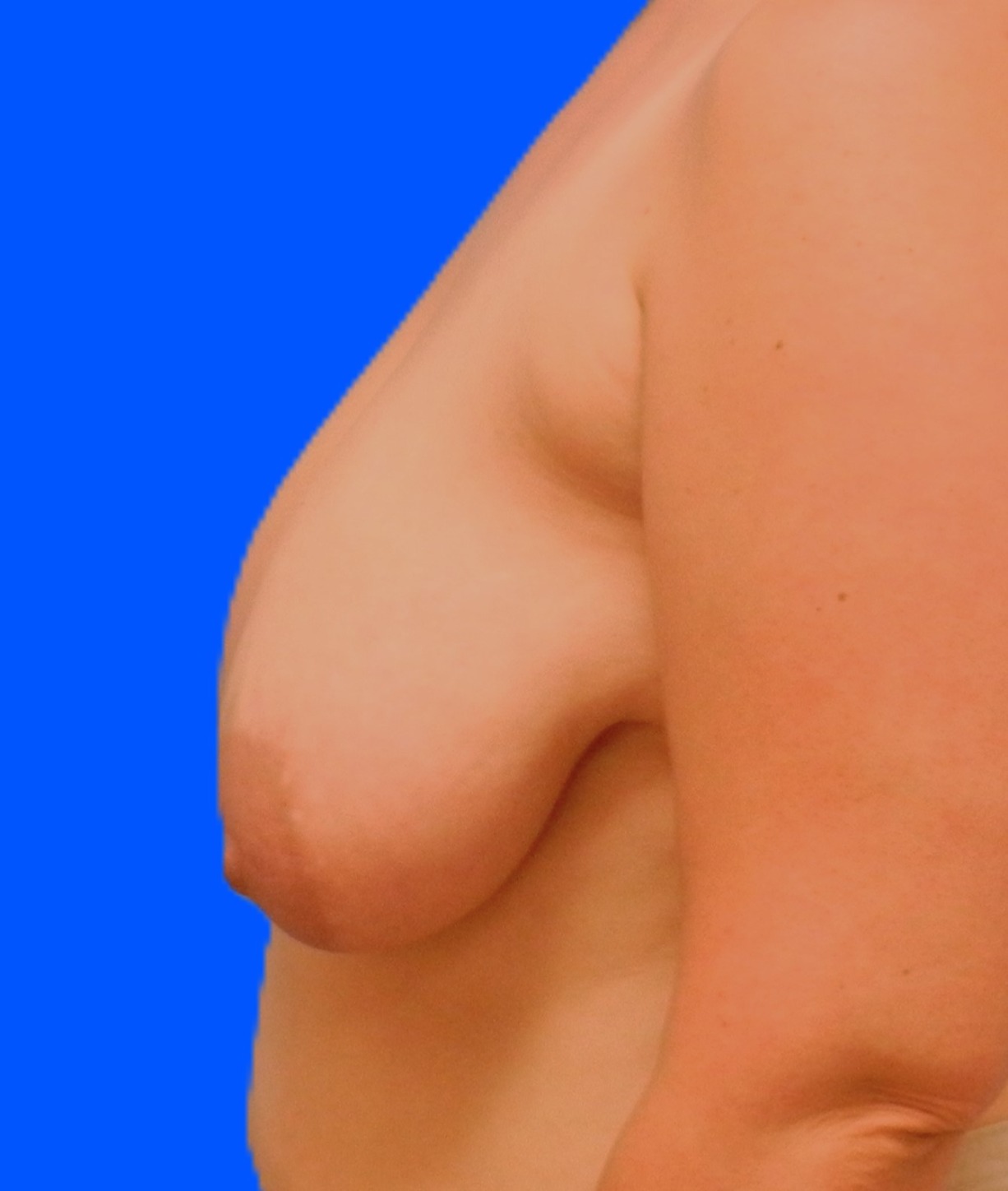 Before Image: Patient Case #0149 - left-side