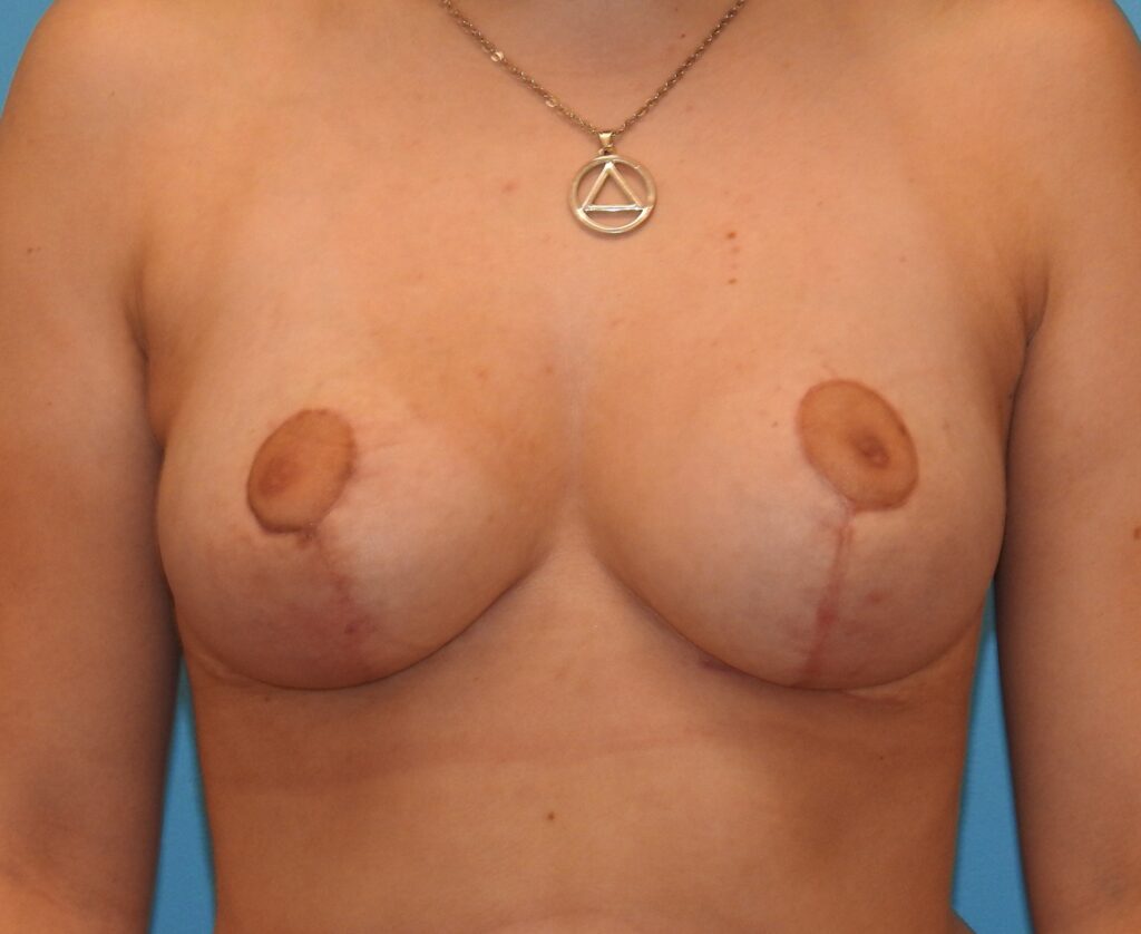 After Image: Patient Case #0150 - front