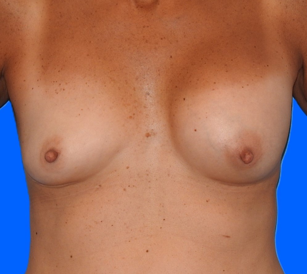 Before Image: Patient Case #0152 - front