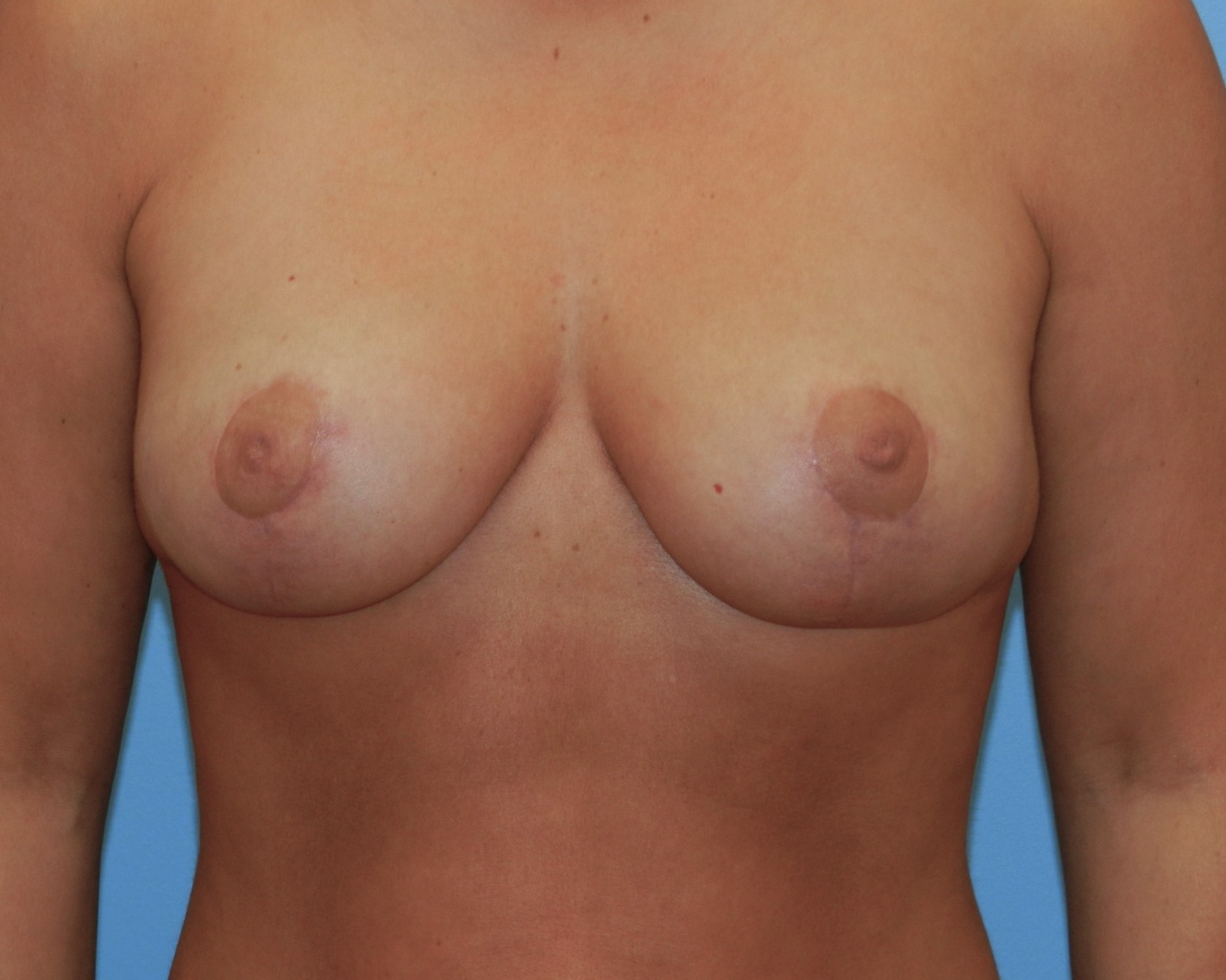 After Image: Patient Case #0153 - front