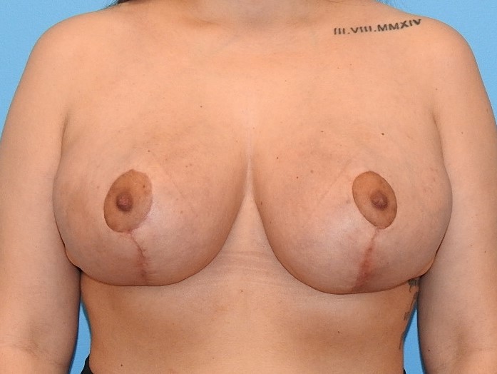 After Image: Patient Case #0155 - front