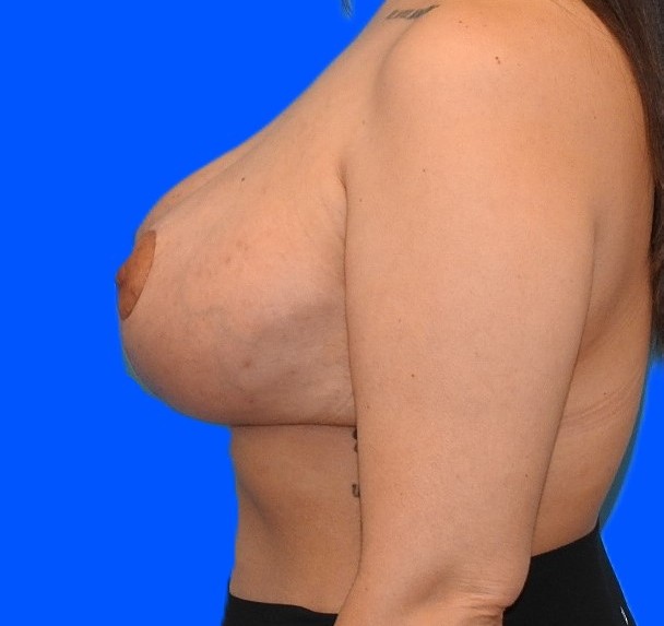 After Image: Patient Case #0155 - left-side