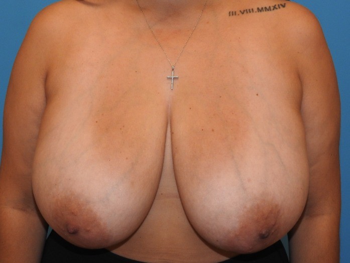 Before Image: Patient Case #0155 - front