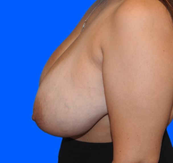 Before Image: Patient Case #0155 - left-side