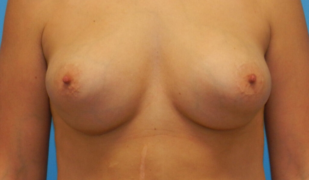After Image: Patient Case #0156 - front