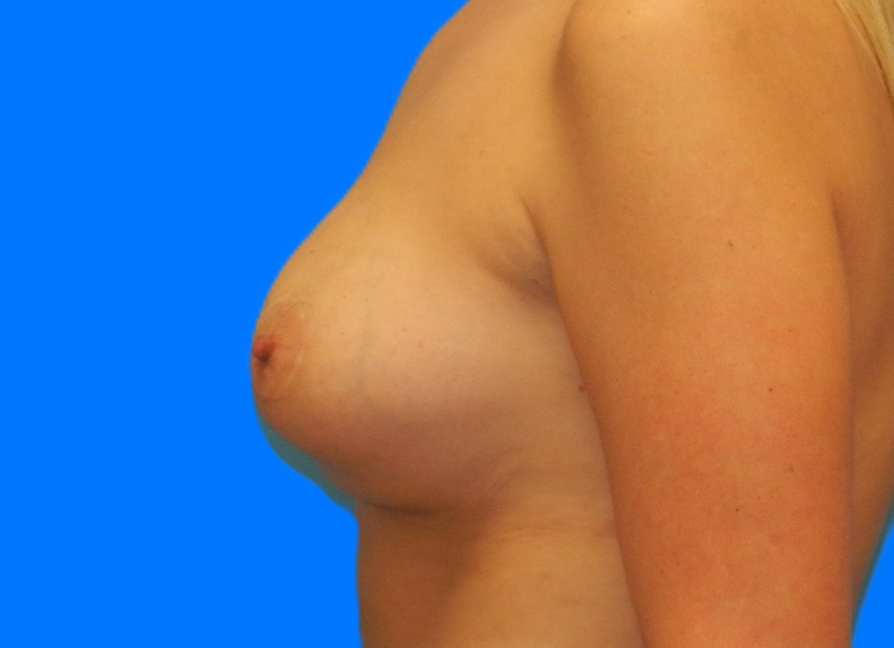 After Image: Patient Case #0156 - left-side