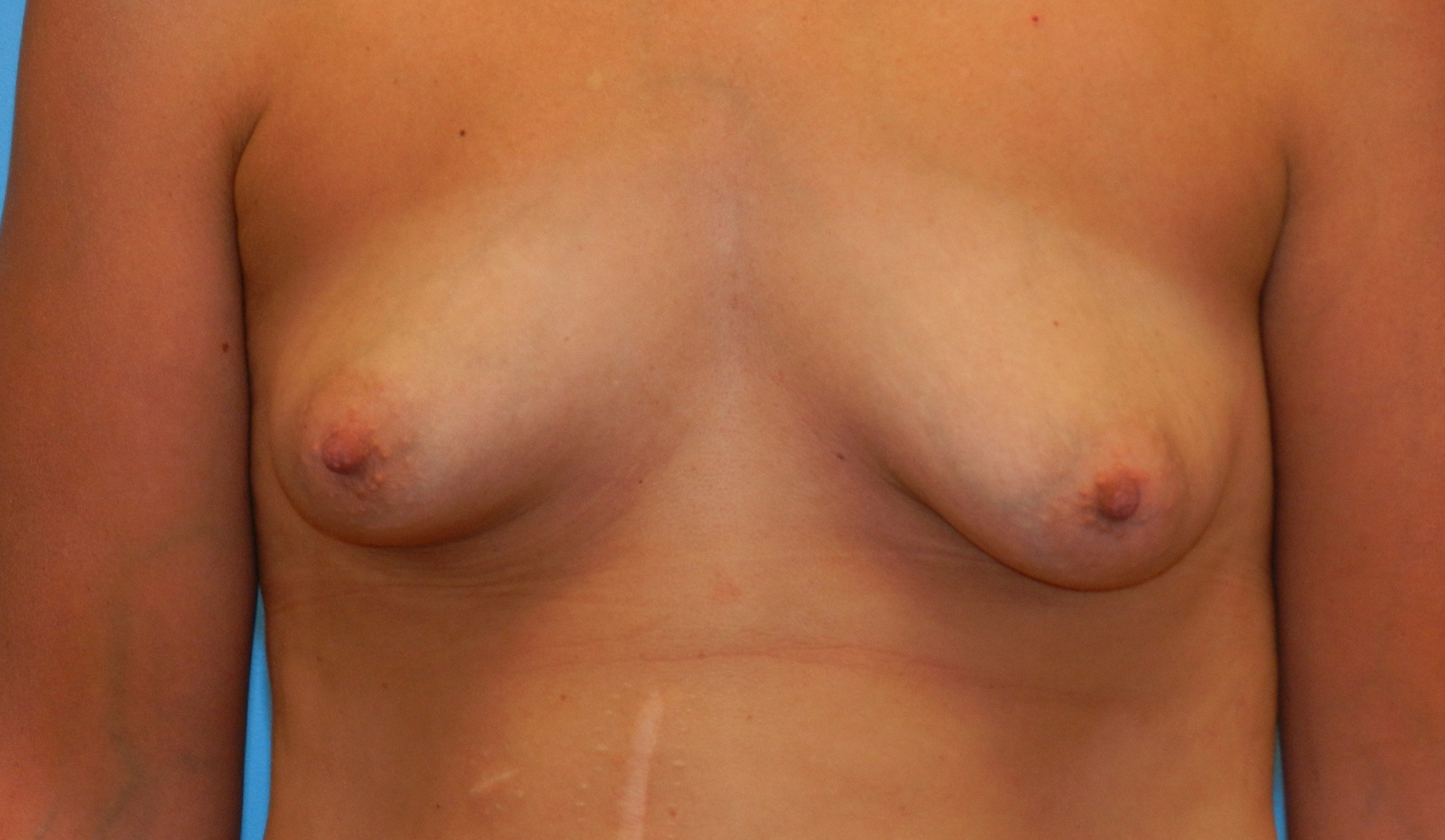 Before Image: Patient Case #0156 - front