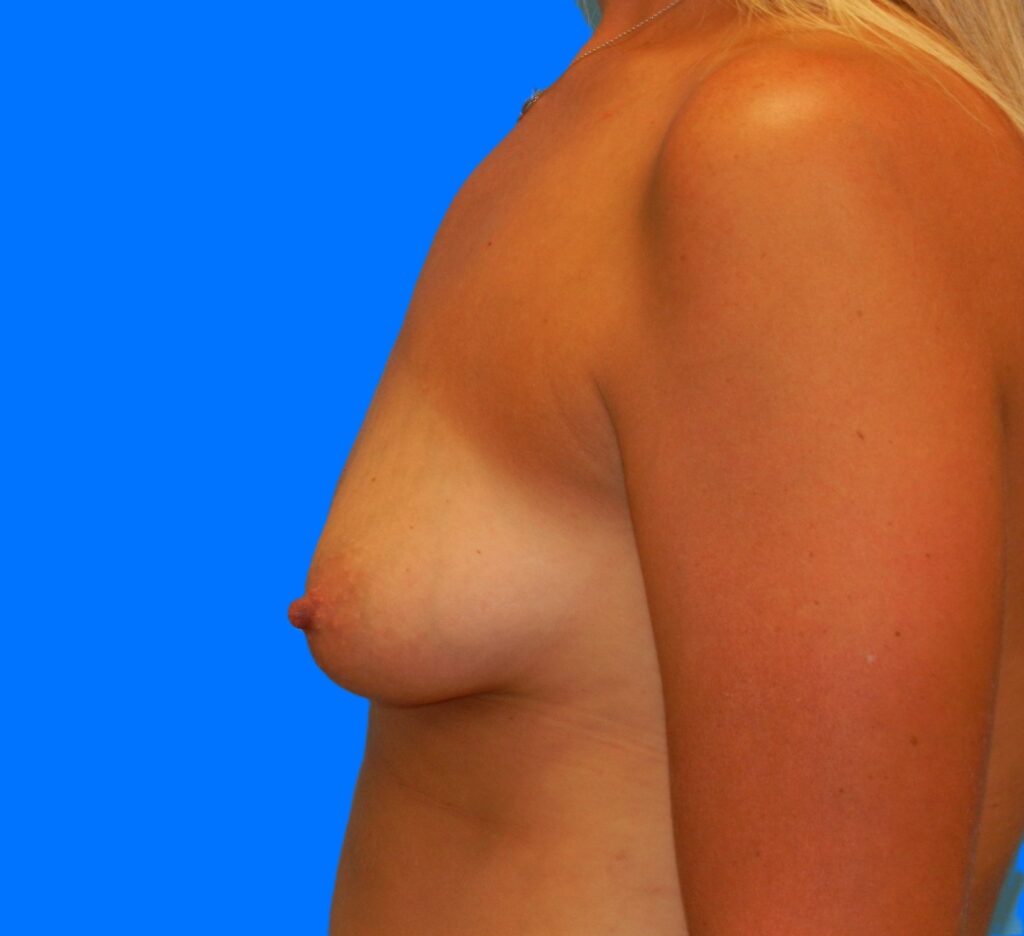 Before Image: Patient Case #0156 - left-side