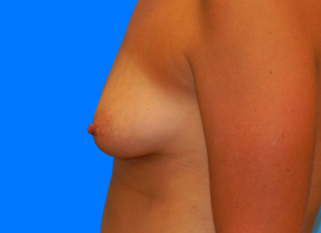 Before Image: Patient Case #0156 - left-side