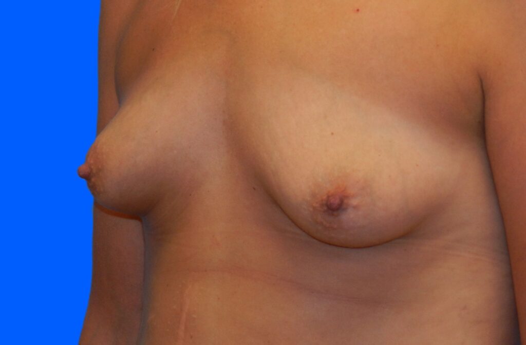 Before Image: Patient Case #0156 - left-front-oblique