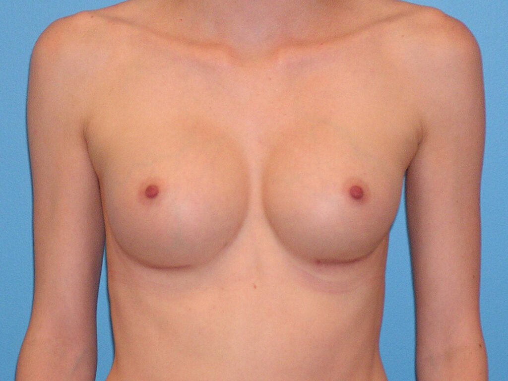 After Image: Patient Case #0158 - front