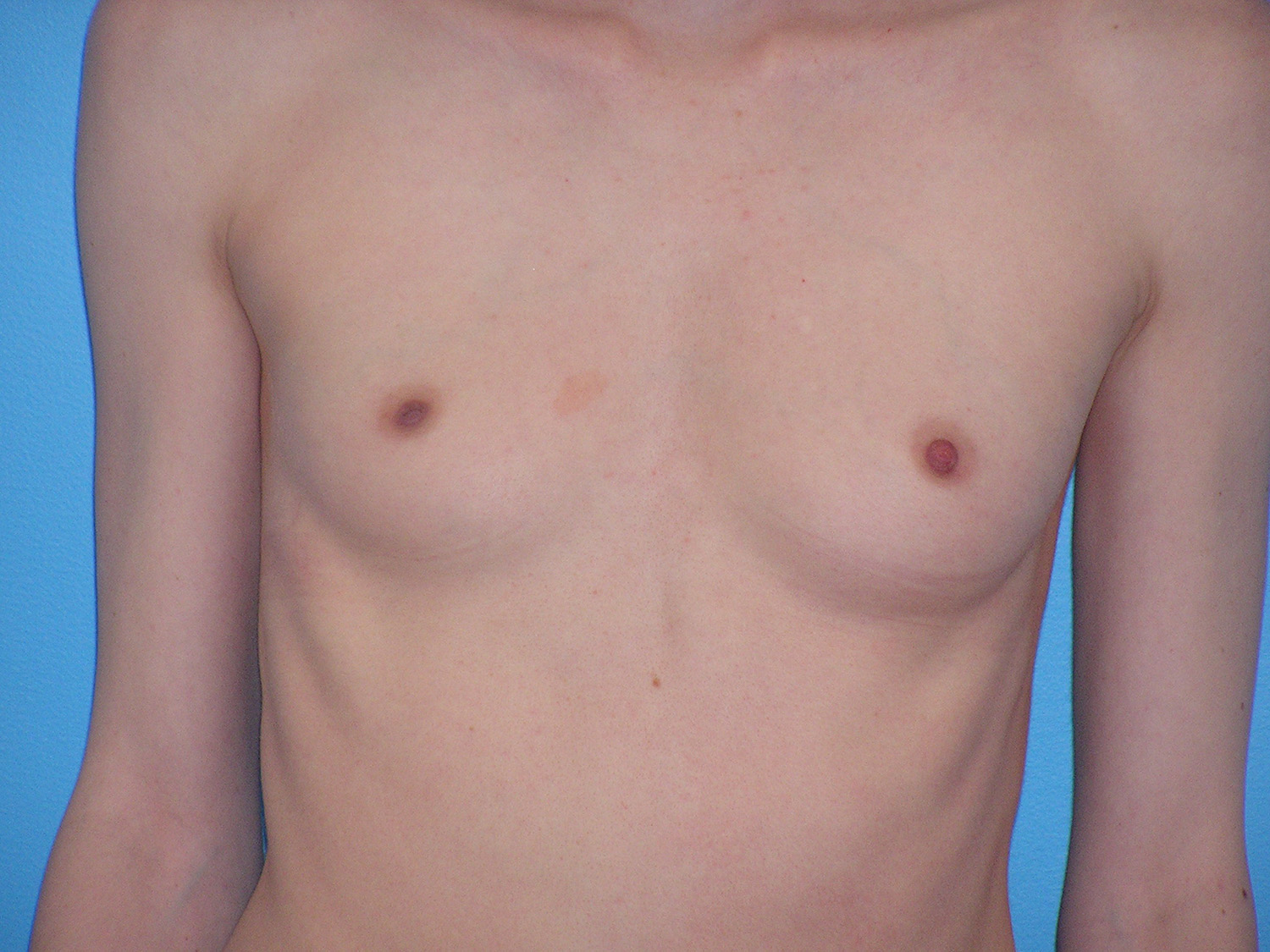 Before Image: Patient Case #0158 - front