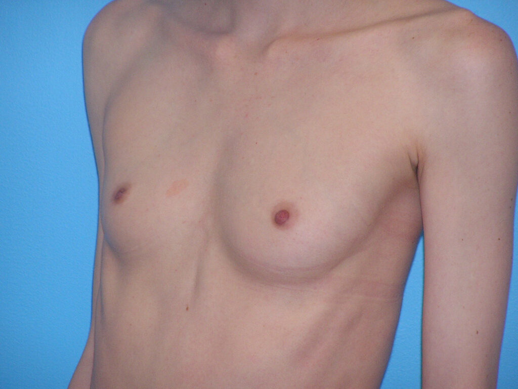 Before Image: Patient Case #0158 - left-front-oblique