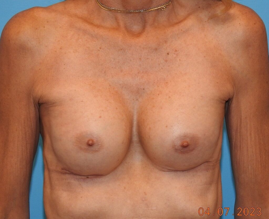 After Image: Patient Case #0159 - front