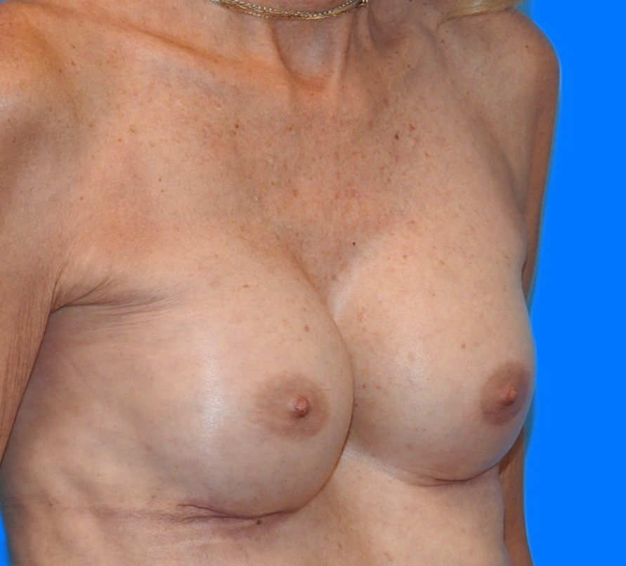After Image: Patient Case #0159 - right-front-oblique