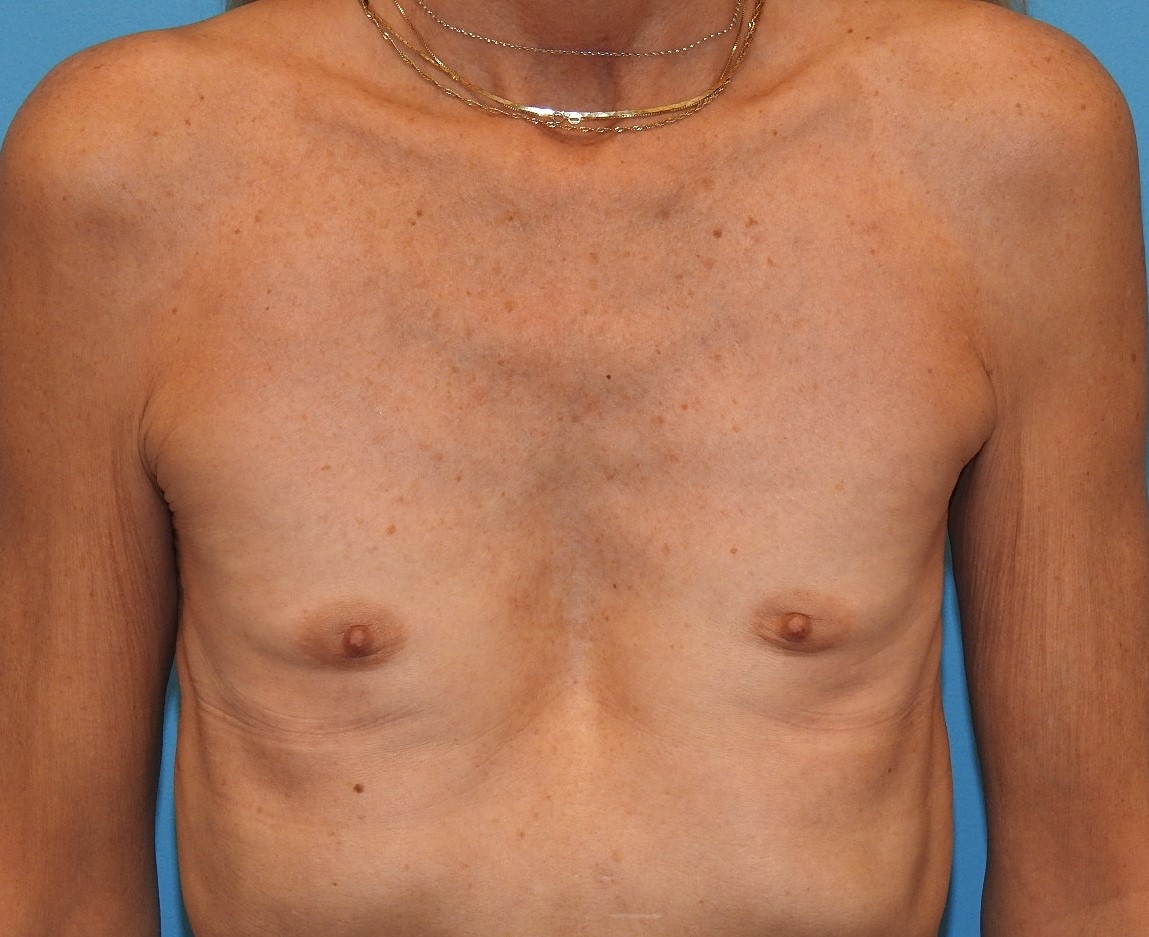 Before Image: Patient Case #0159 - front