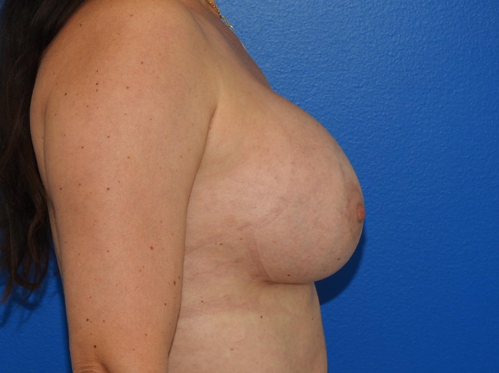 After Image: Patient Case #0165 - right-side