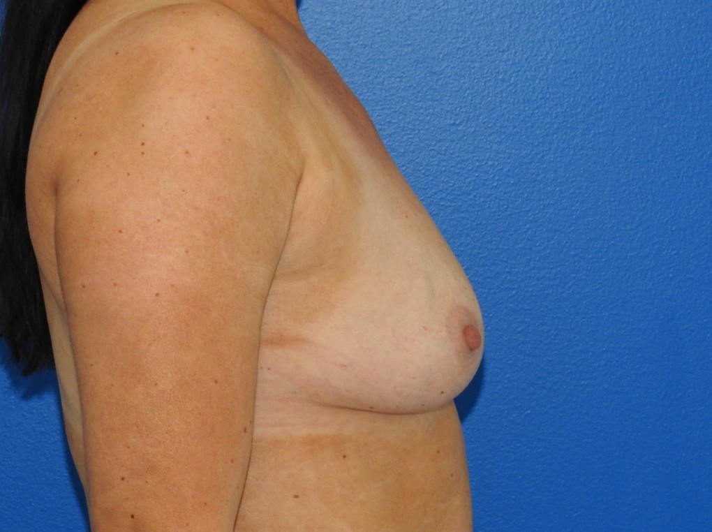 Before Image: Patient Case #0165 - right-side