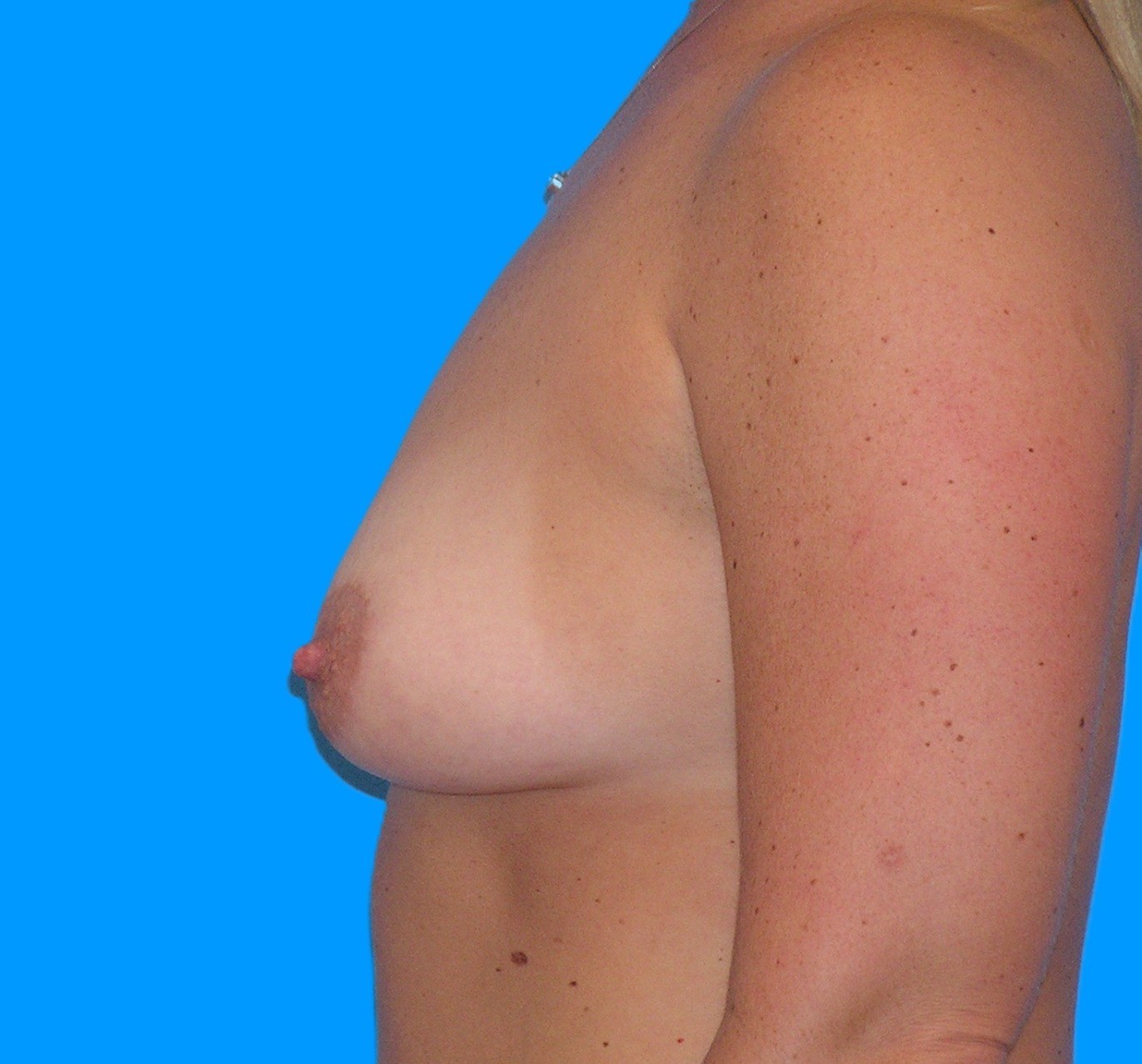 Before Image: Patient Case #0166 - left-side