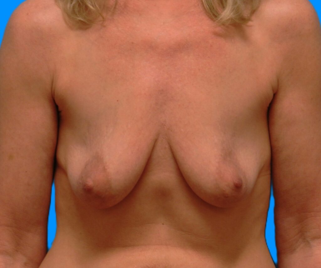 Before Image: Patient Case #0169 - front