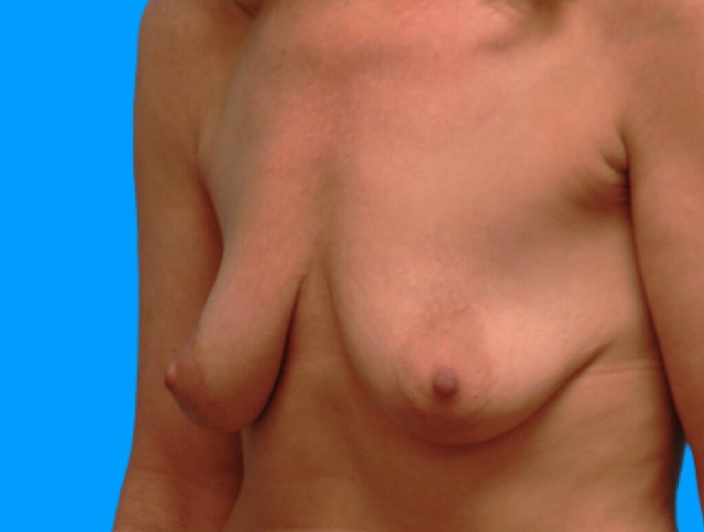 Before Image: Patient Case #0169 - left-front-oblique