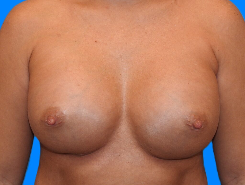 After Image: Patient Case #0170 - front