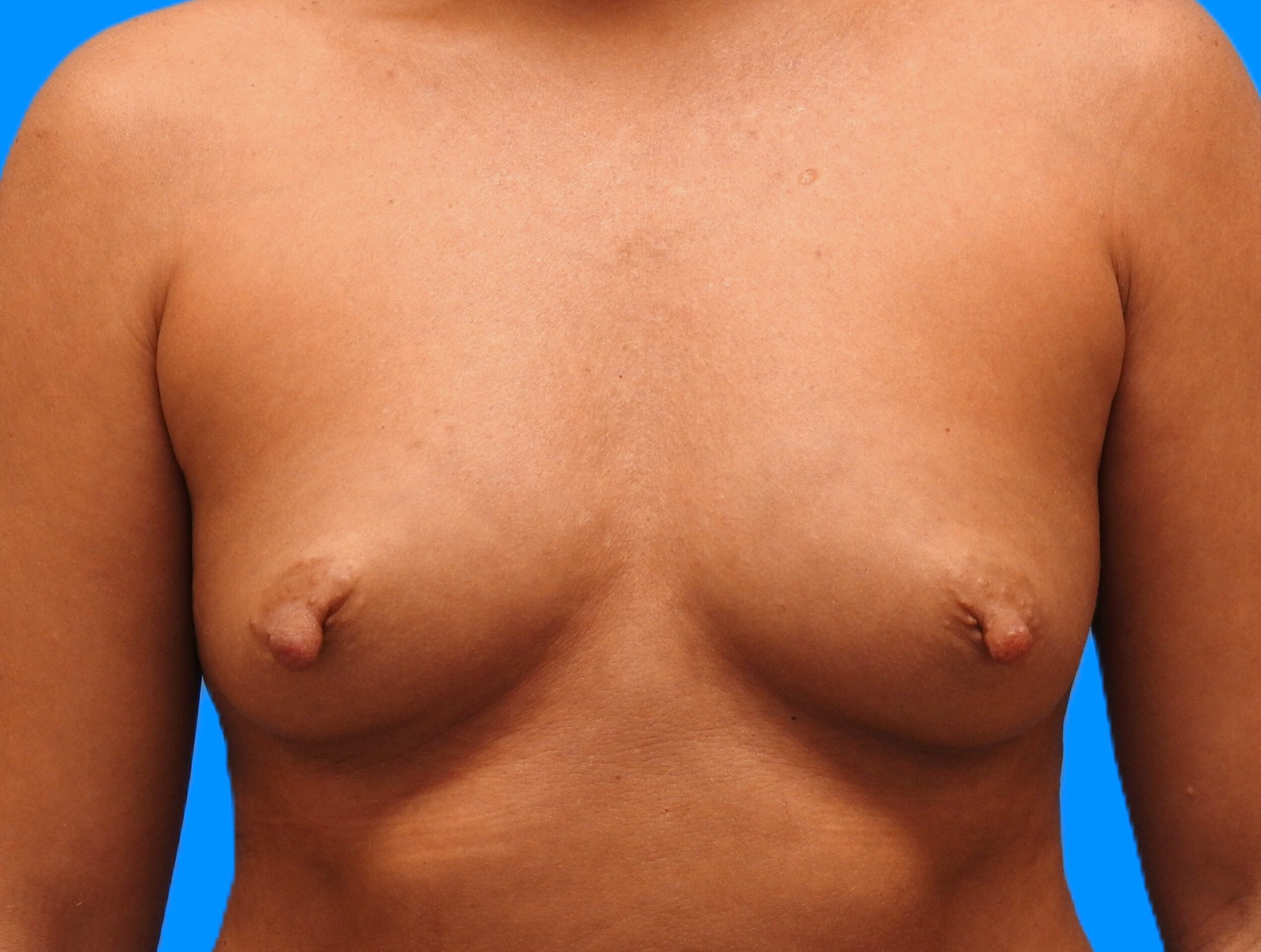 Before Image: Patient Case #0170 - front