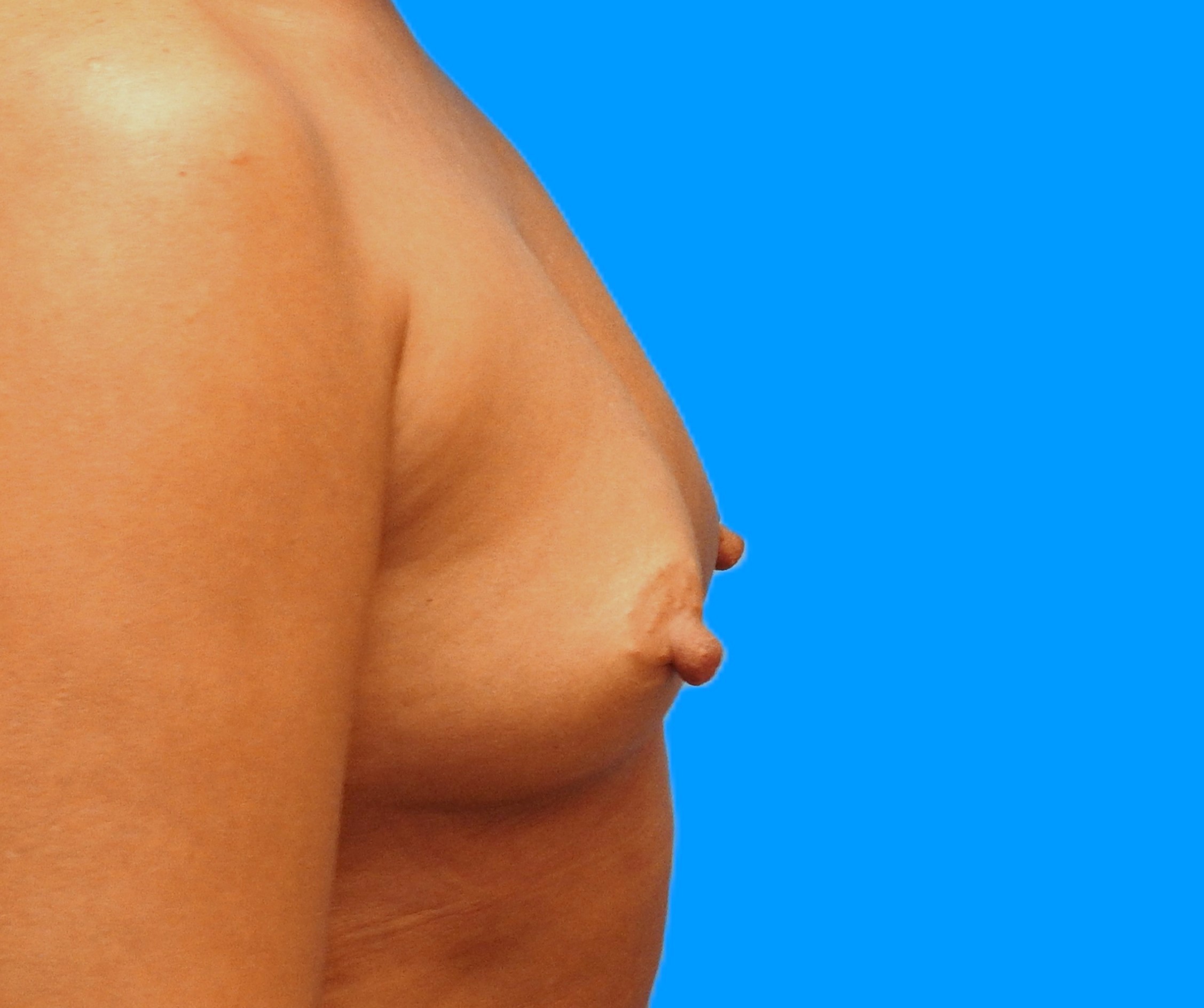 Before Image: Patient Case #0170 - right-side