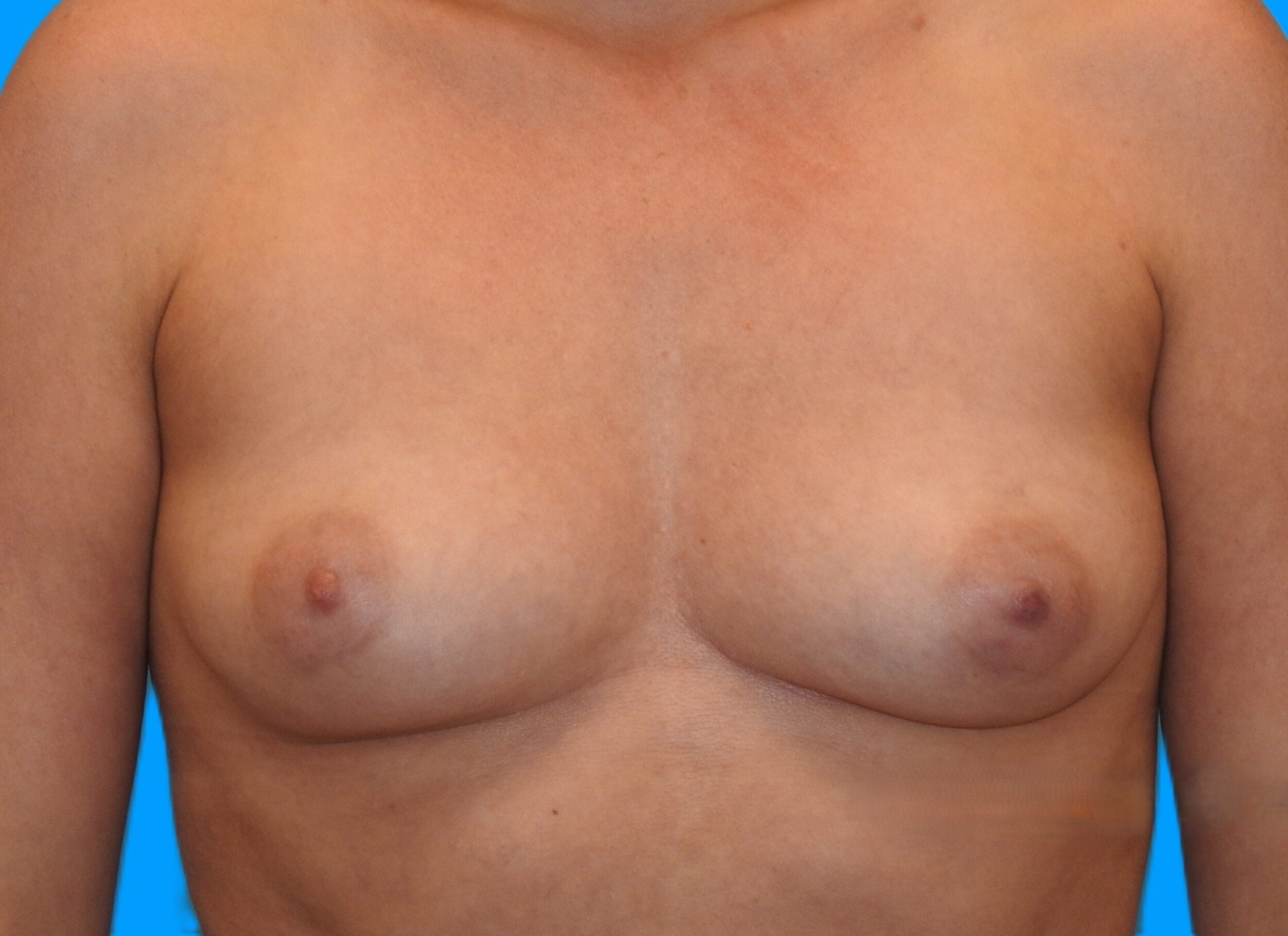 Before Image: Patient Case #0171 - front