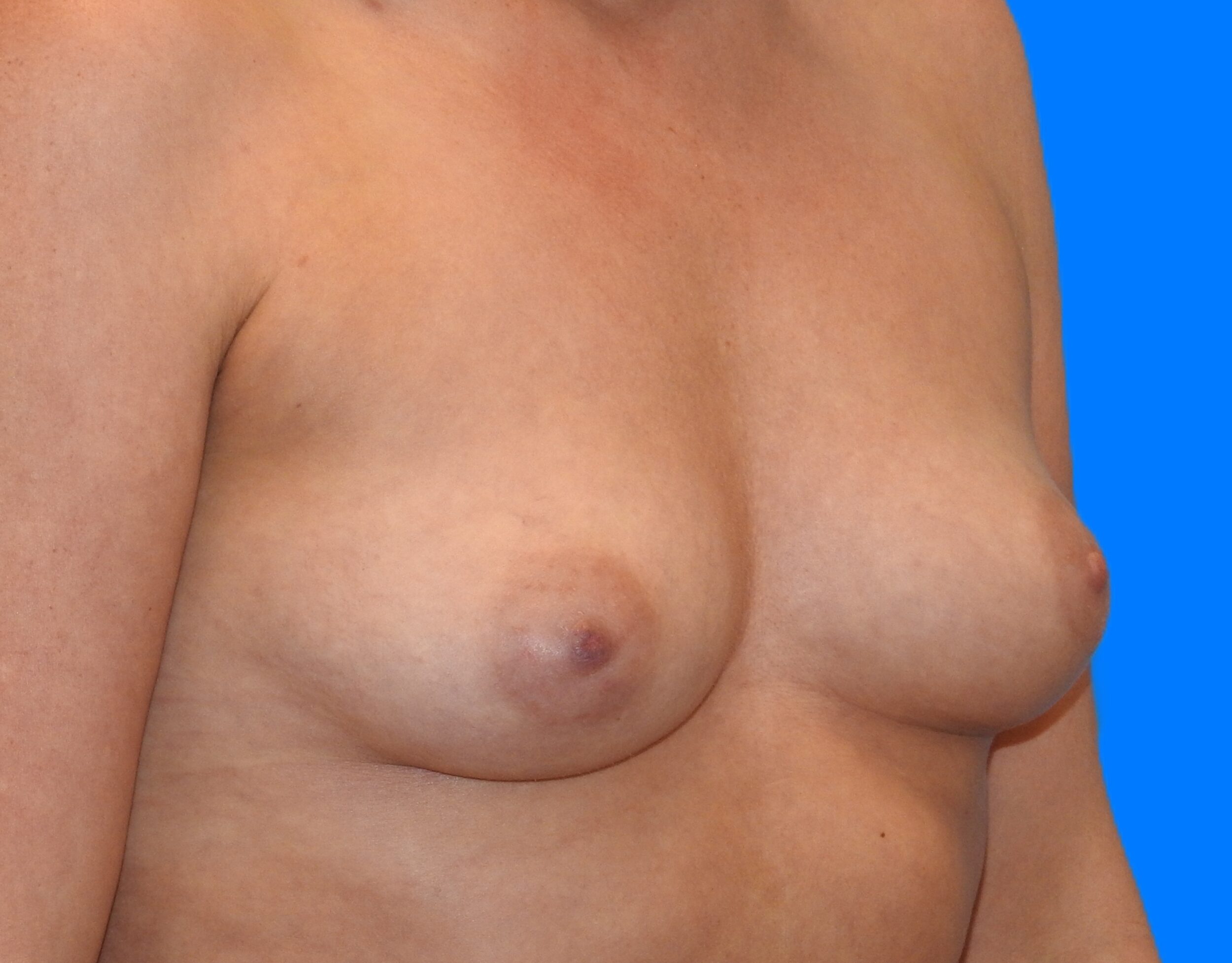 Before Image: Patient Case #0171 - right-front-oblique