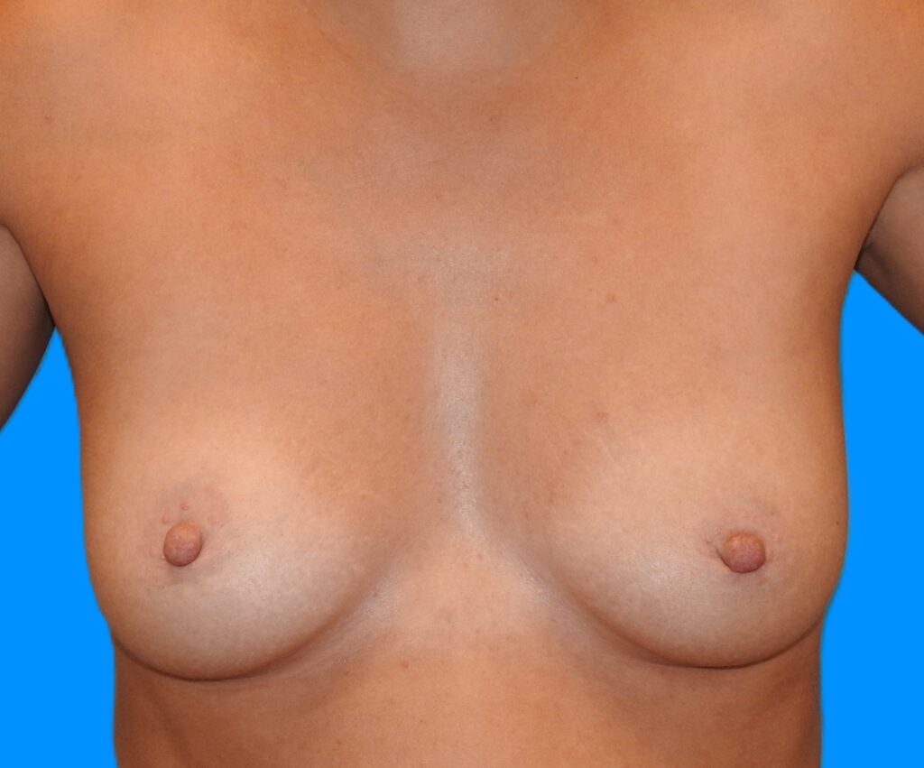 Before Image: Patient Case #0172 - front