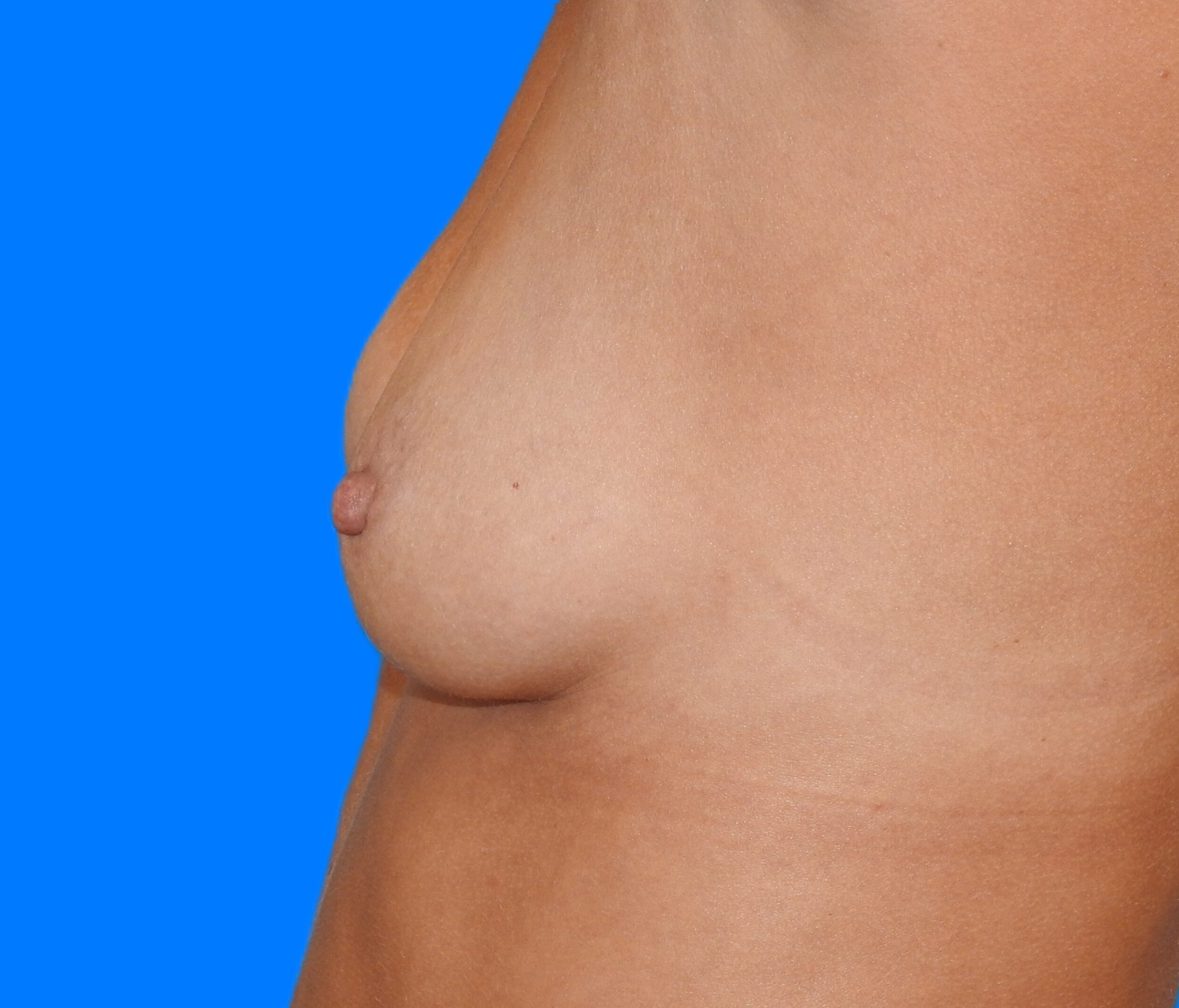 Before Image: Patient Case #0172 - left-side