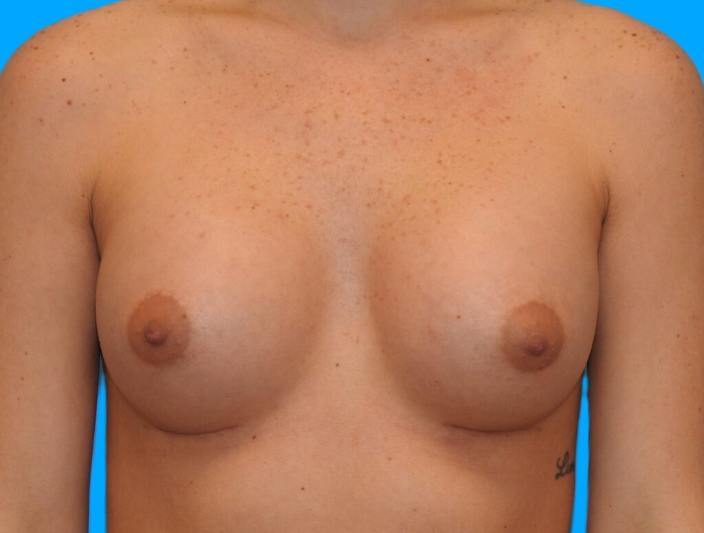 After Image: Patient Case #0173 - front