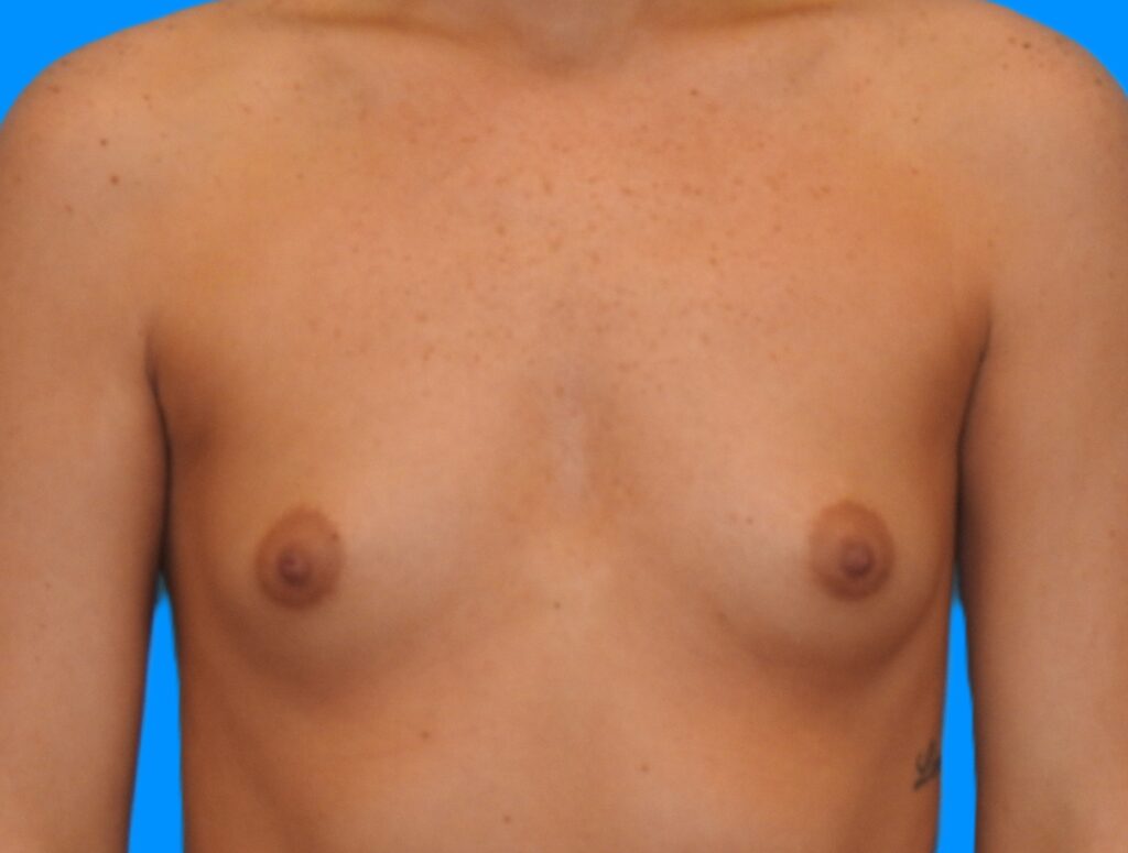 Before Image: Patient Case #0173 - front