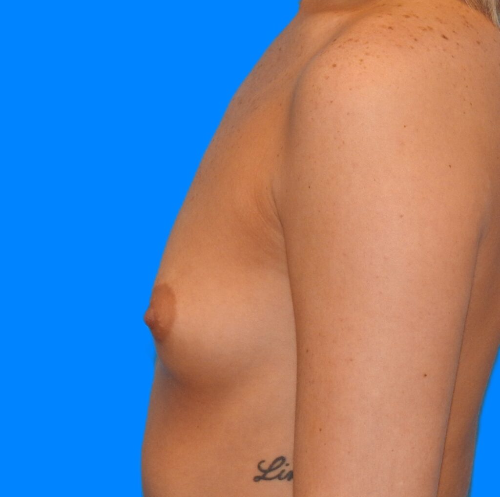 Before Image: Patient Case #0173 - left-side