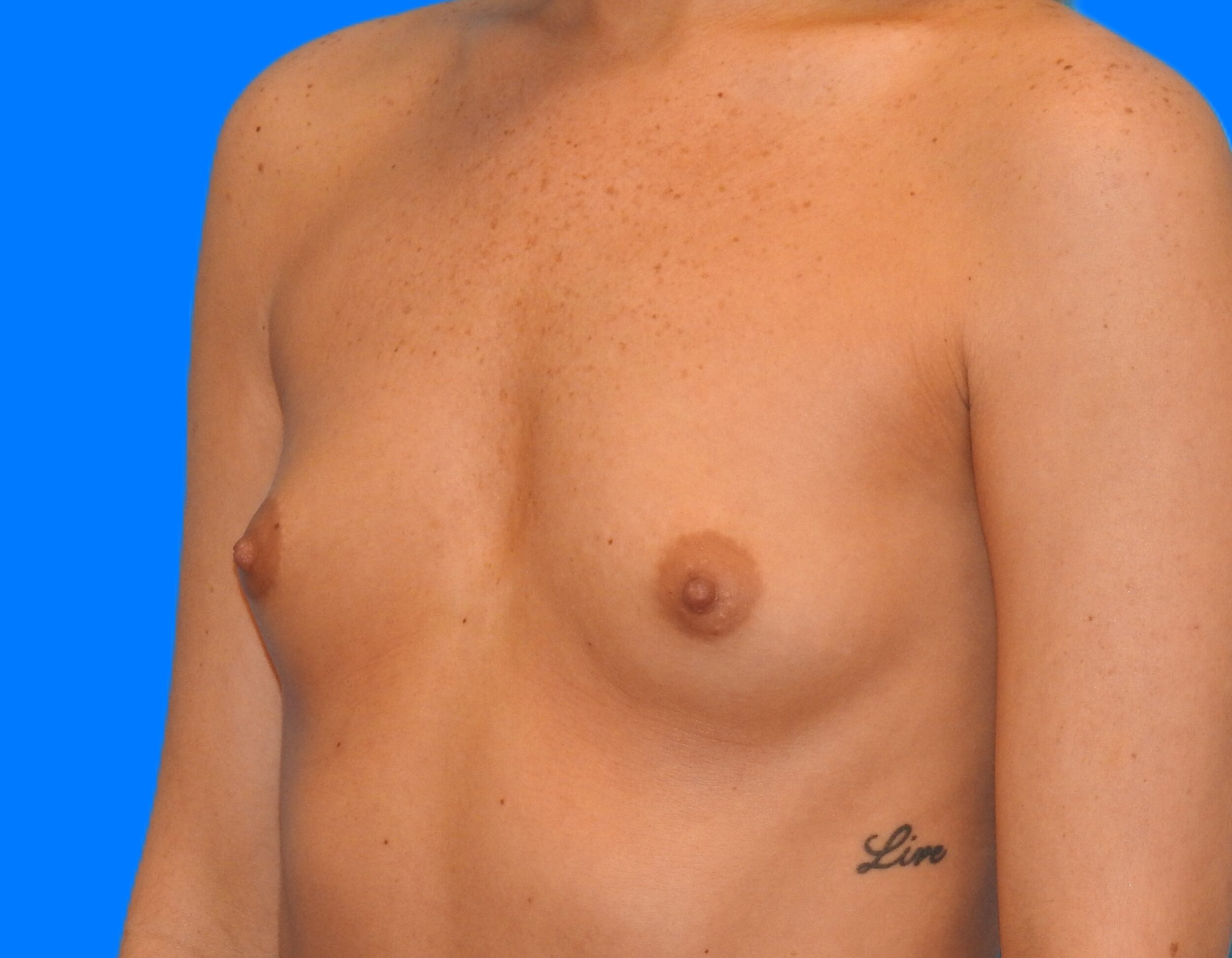 Before Image: Patient Case #0173 - left-front-oblique