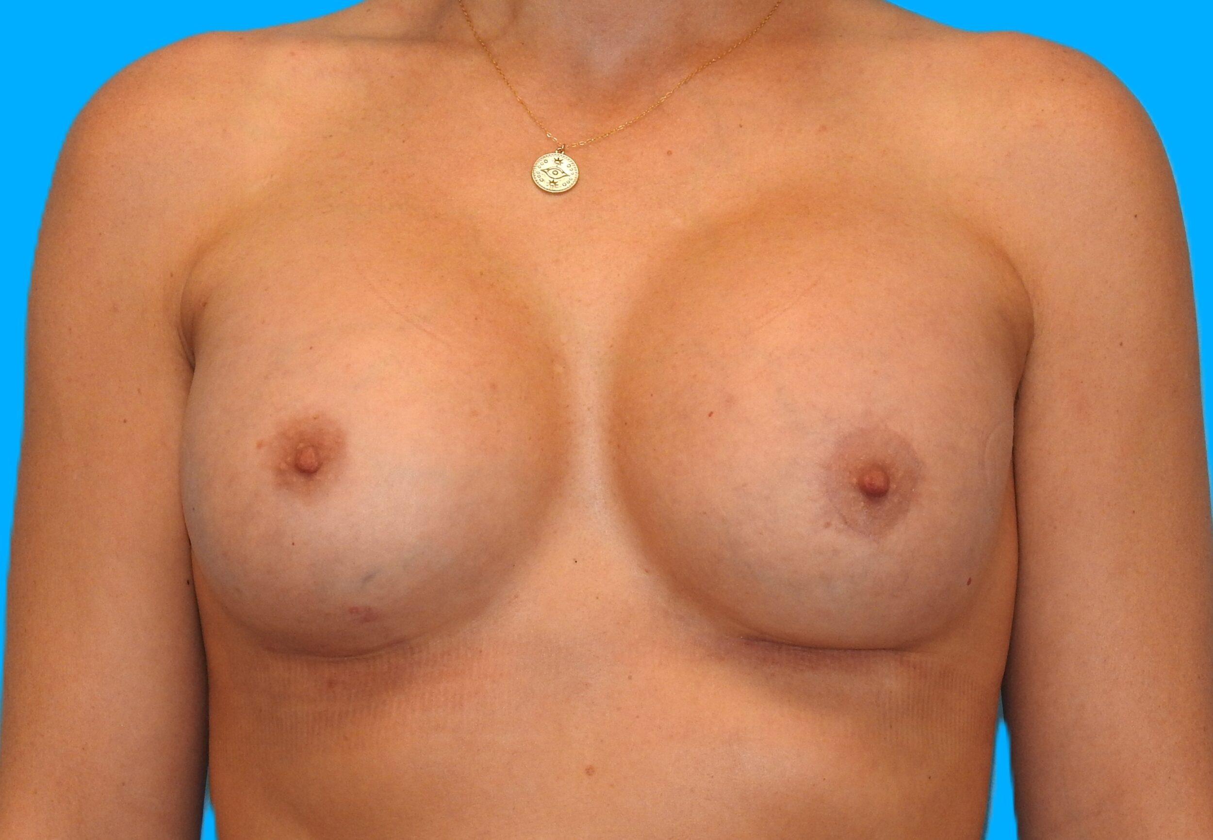 After Image: Patient Case #0174 - front