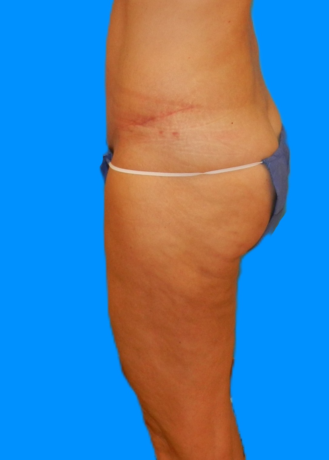 After Image: Patient Case #1174 - left-side