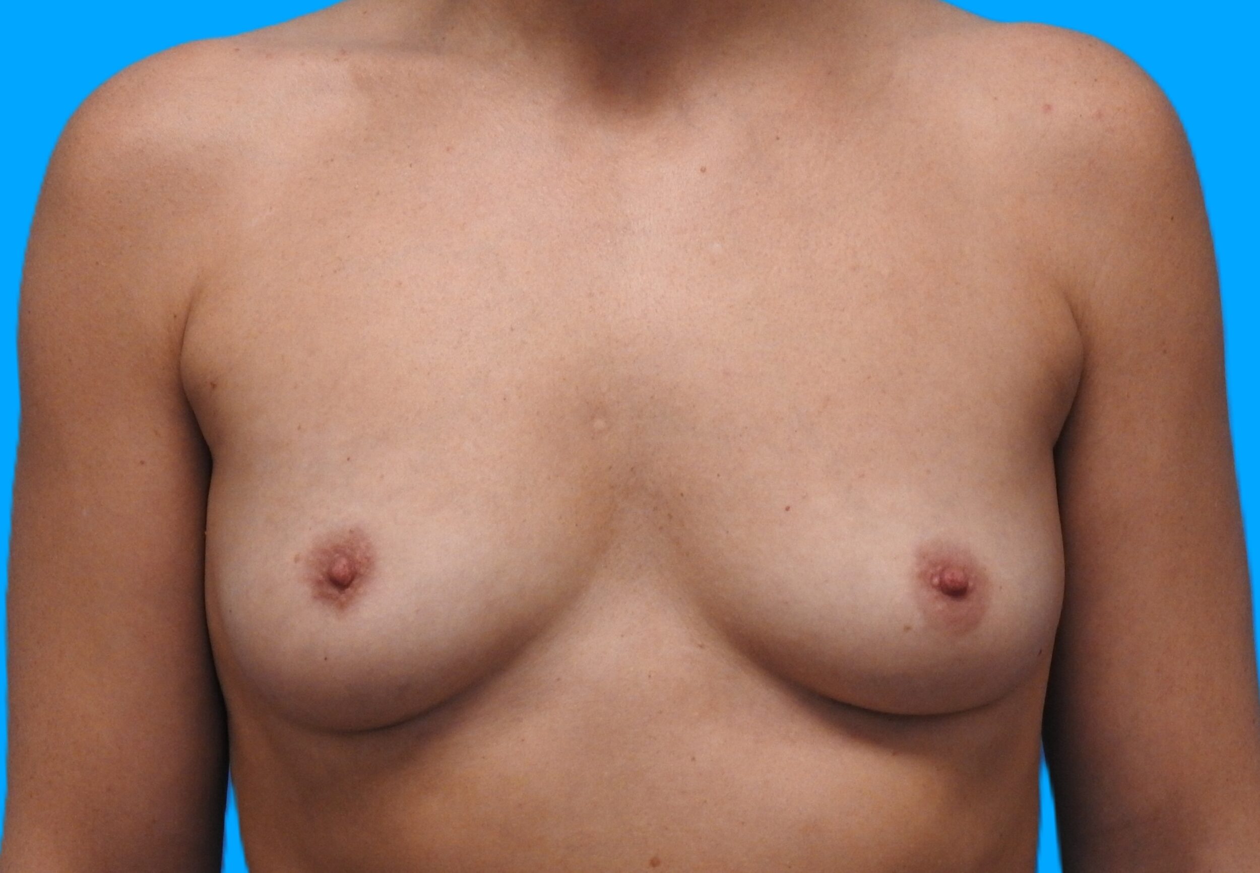 Before Image: Patient Case #0174 - front
