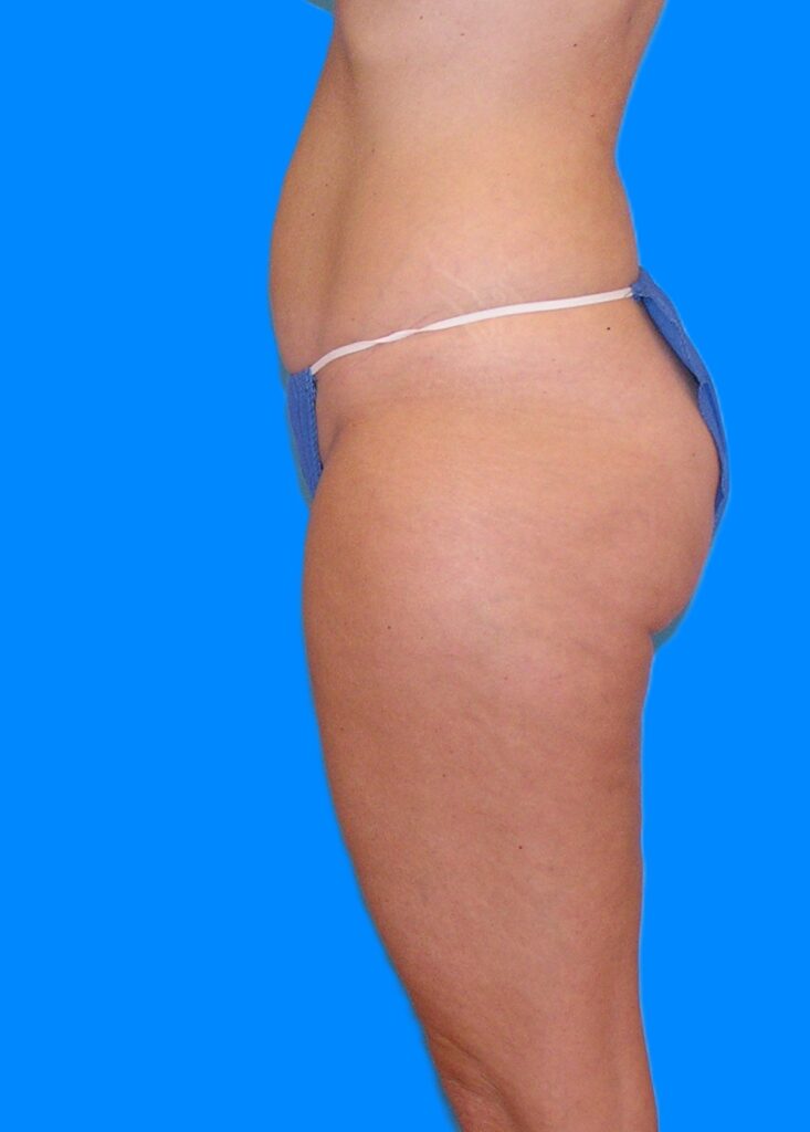 Before Image: Patient Case #1174 - left-side