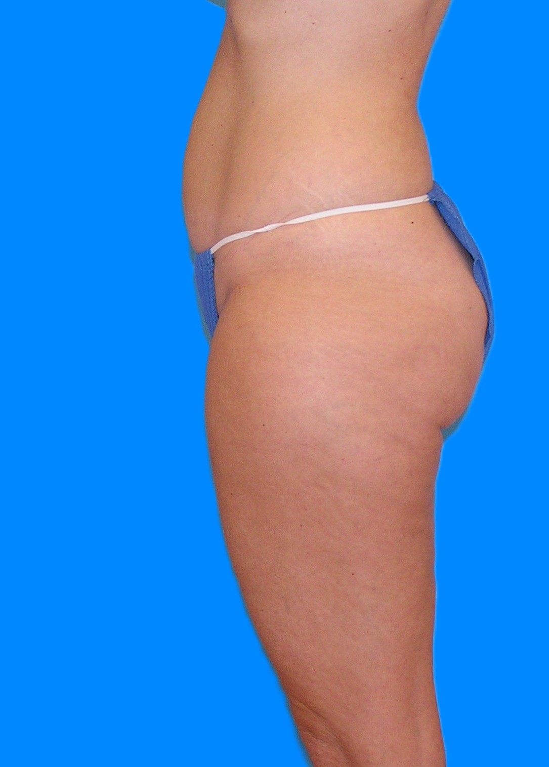 Before Image: Patient Case #1174 - left-side