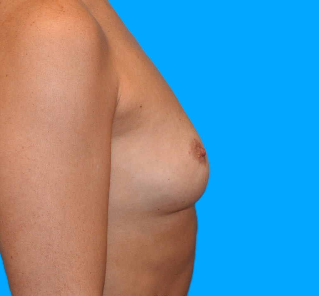 Before Image: Patient Case #0174 - right-side