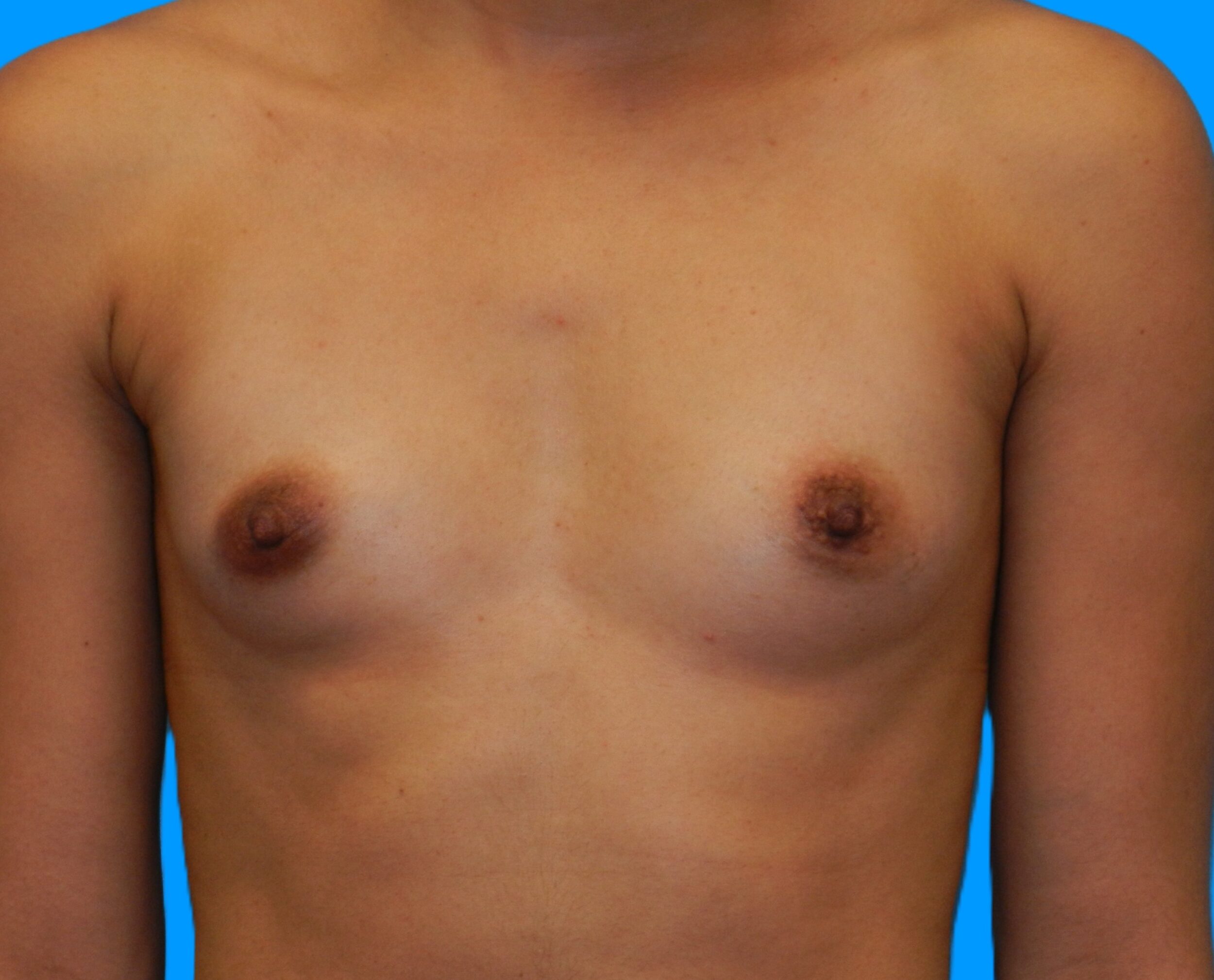 Before Image: Patient Case #0176 - front